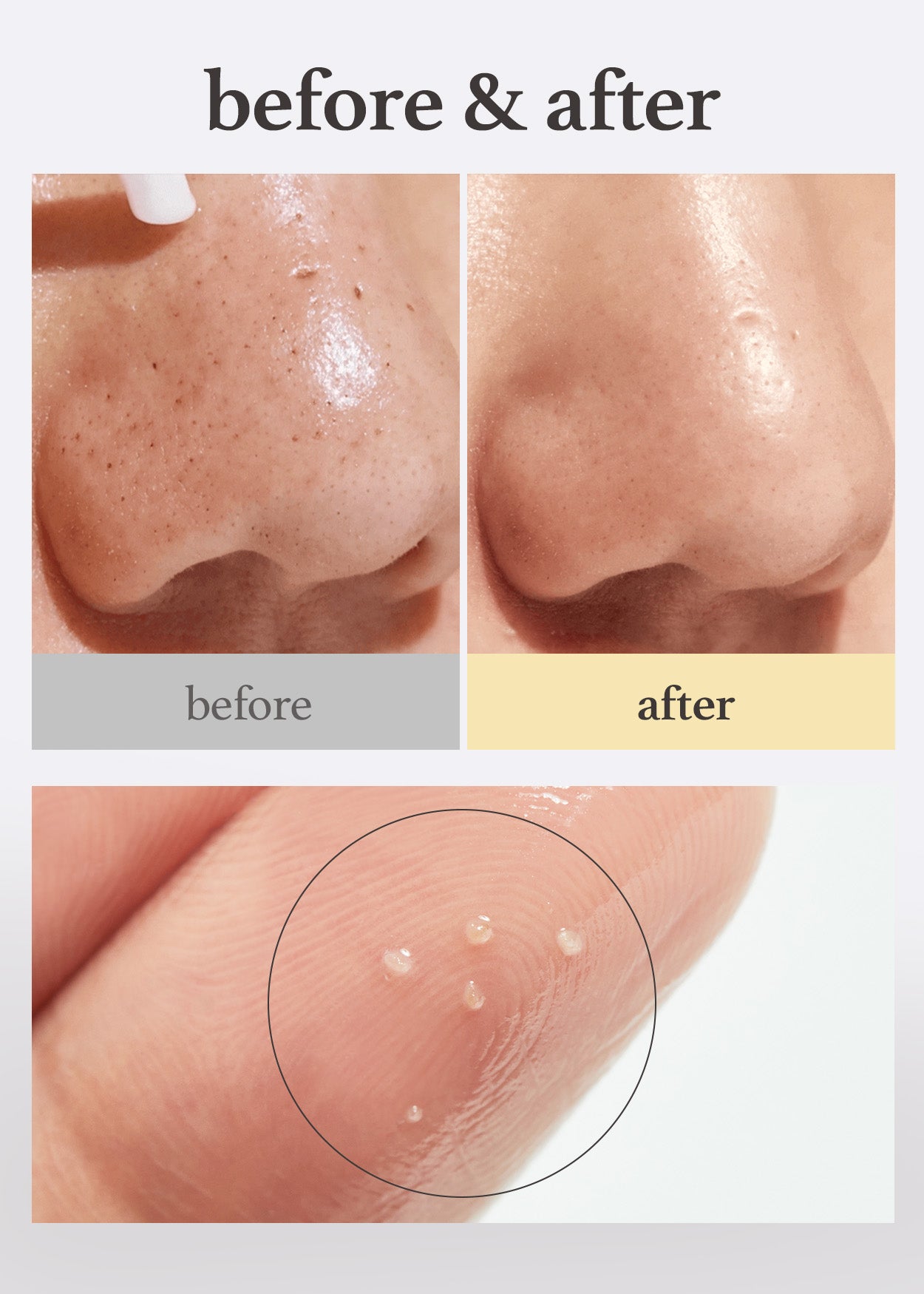Nose blackhead and sebum removal comparison before and after using Nooni LHA Cleansing Oil